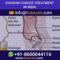 Low Cost Ovarian Cancer Treatment in India