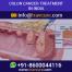 Low Cost Colon Cancer Treatment in India 