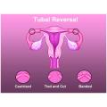 Tubal ligation reversal surgery offers high quality solutions at affordable cost 