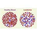 Low cost Leukemia Treatment in India: A step forward getting relief from the dreaded disease